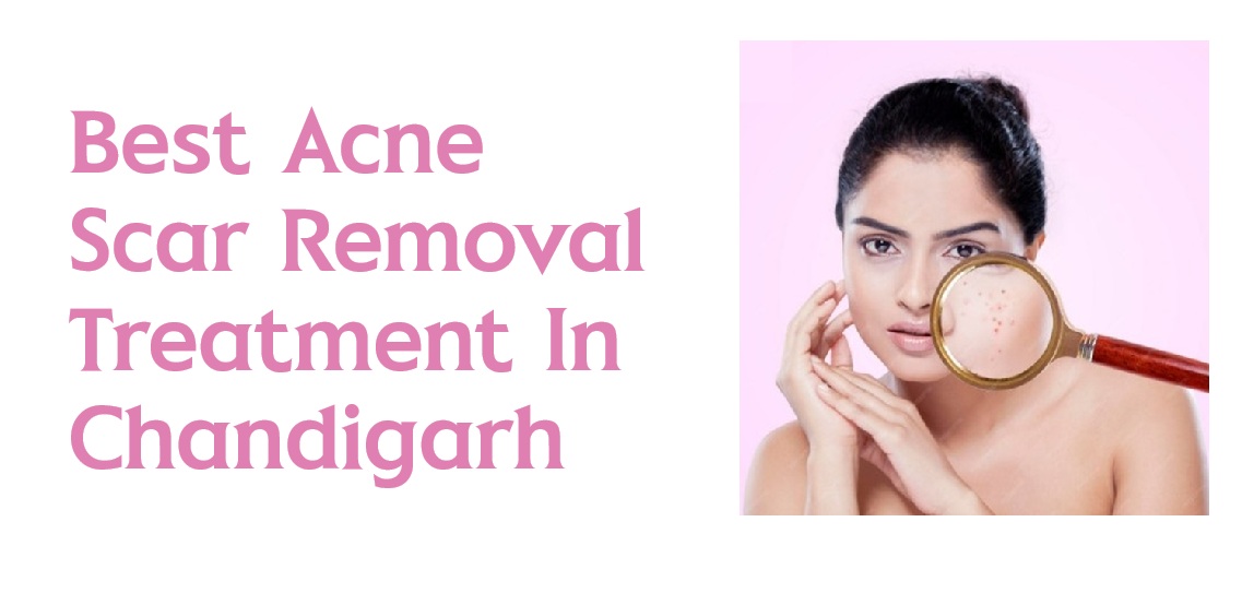 Best Acne Scar Removal Treatment in Chandigarh